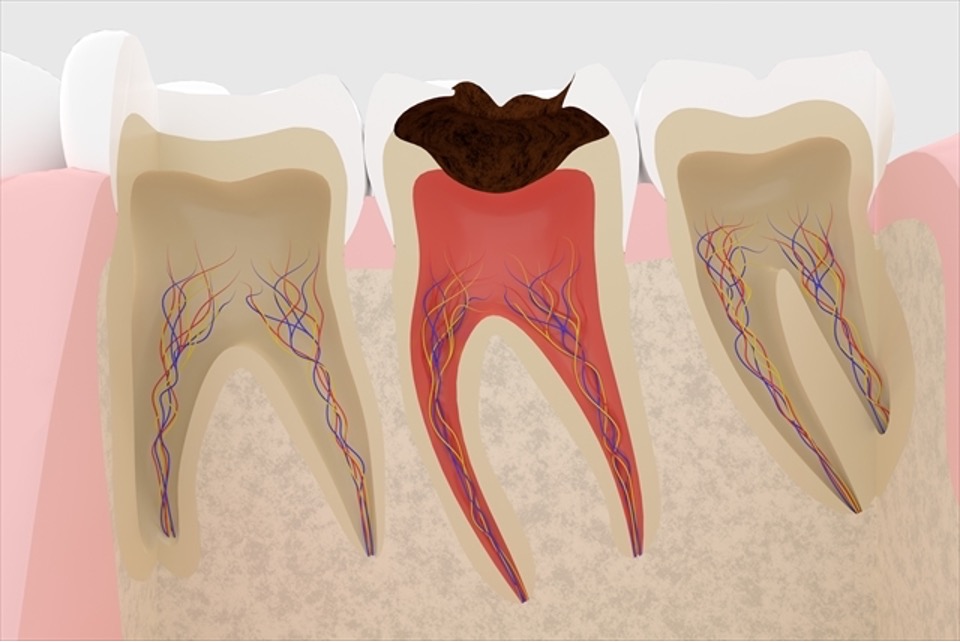 なぜ根管治療が治らないことがあるのか?