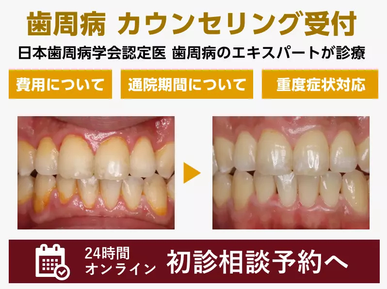 歯周病治療相談"