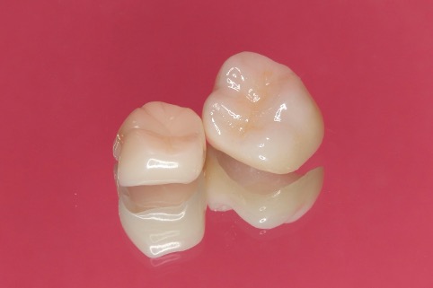 歯の白い詰め物とは？保険適用・値段・銀歯との違いまで徹底解説！